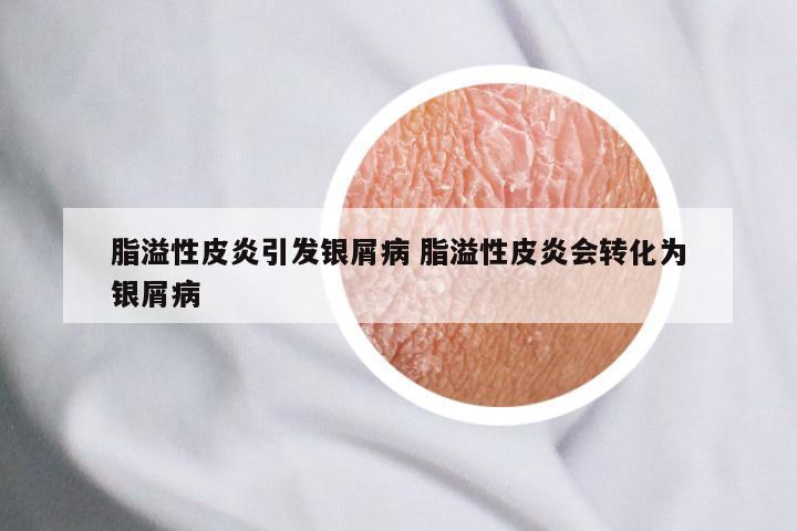 脂溢性皮炎引发银屑病 脂溢性皮炎会转化为银屑病
