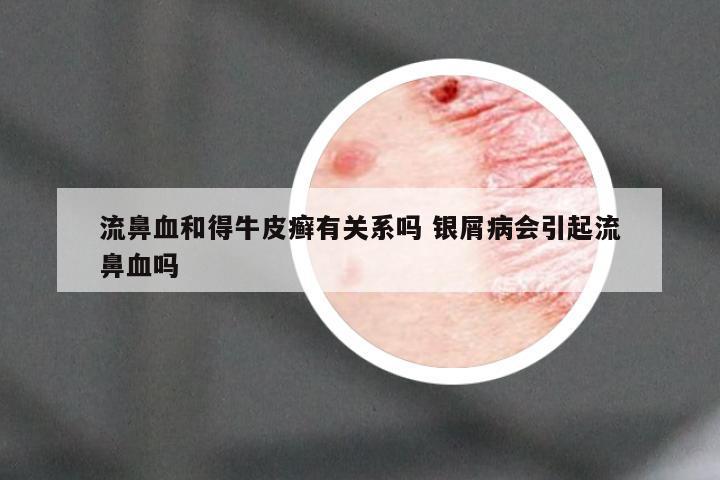 流鼻血和得牛皮癣有关系吗 银屑病会引起流鼻血吗