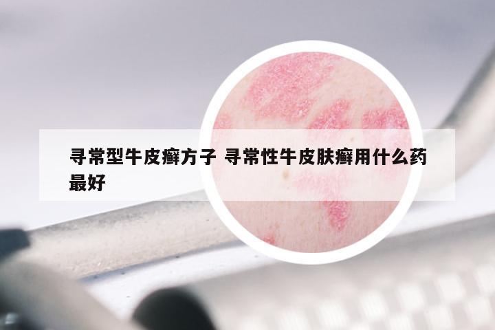 寻常型牛皮癣方子 寻常性牛皮肤癣用什么药最好