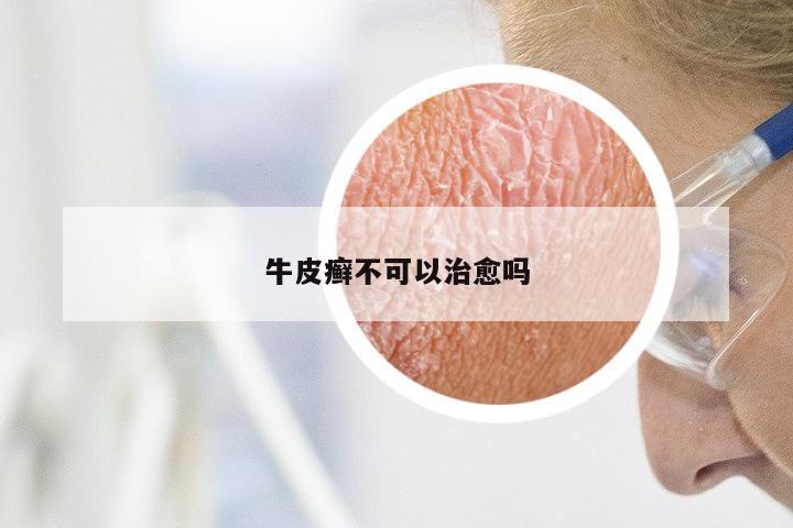 牛皮癣不可以治愈吗