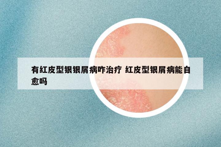 有红皮型银银屑病咋治疗 红皮型银屑病能自愈吗