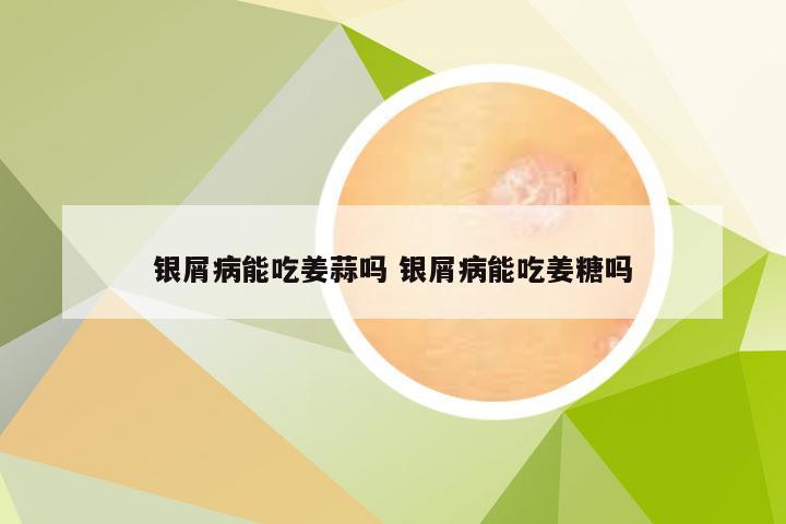 银屑病能吃姜蒜吗 银屑病能吃姜糖吗