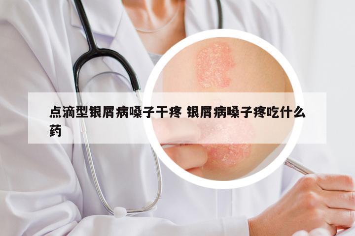 点滴型银屑病嗓子干疼 银屑病嗓子疼吃什么药