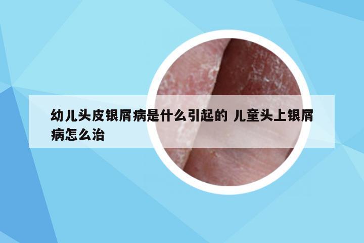 幼儿头皮银屑病是什么引起的 儿童头上银屑病怎么治