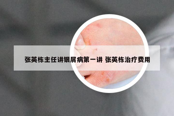 张英栋主任讲银屑病第一讲 张英栋治疗费用