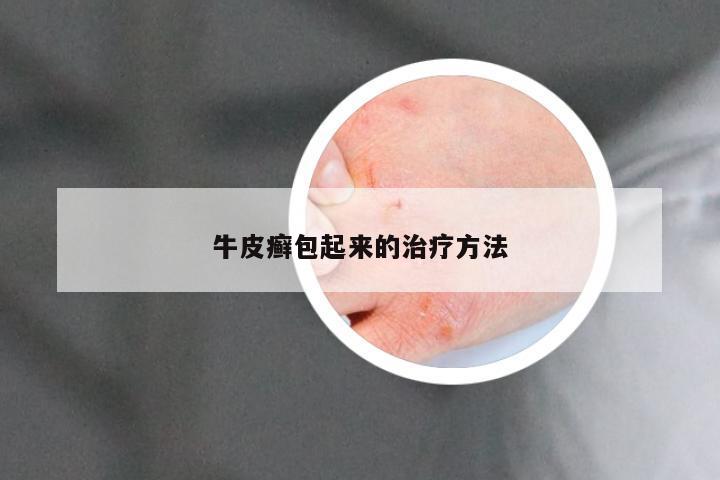牛皮癣包起来的治疗方法