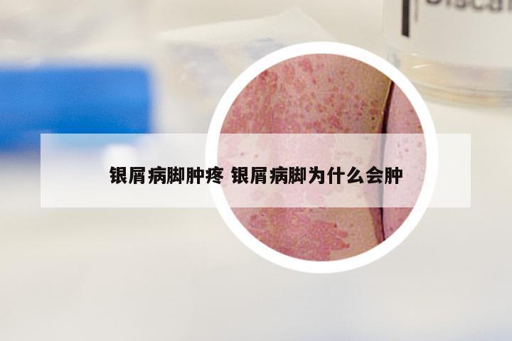 银屑病脚肿疼 银屑病脚为什么会肿
