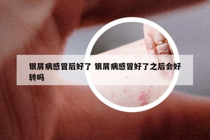 银屑病感冒后好了 银屑病感冒好了之后会好转吗