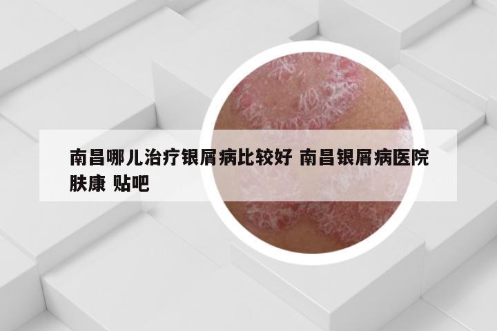 南昌哪儿治疗银屑病比较好 南昌银屑病医院肤康 贴吧