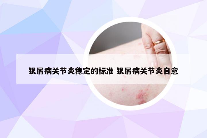 银屑病关节炎稳定的标准 银屑病关节炎自愈