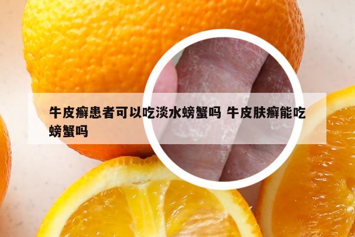 牛皮癣患者可以吃淡水螃蟹吗 牛皮肤癣能吃螃蟹吗