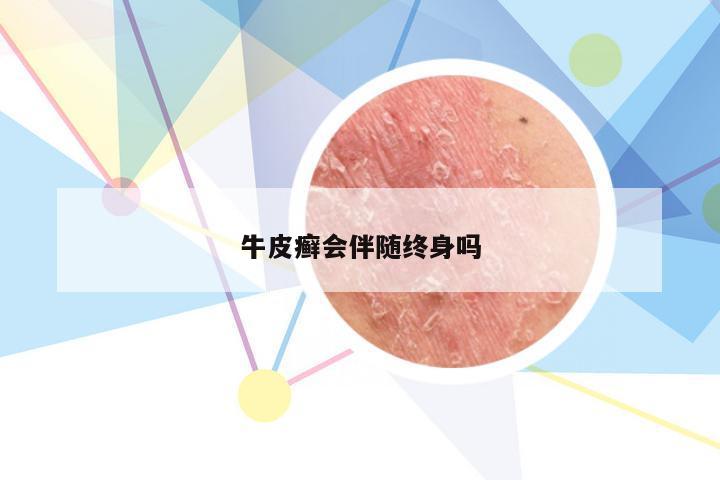 牛皮癣会伴随终身吗