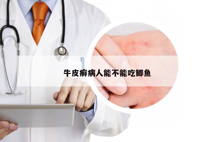 牛皮癣病人能不能吃鲫鱼