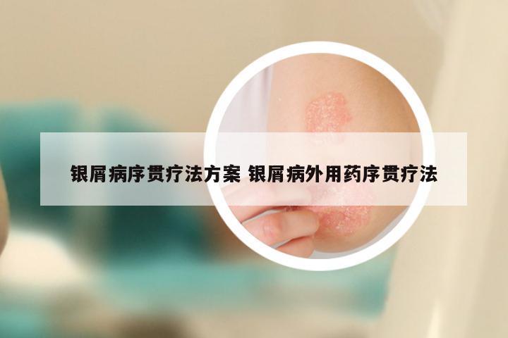 银屑病序贯疗法方案 银屑病外用药序贯疗法