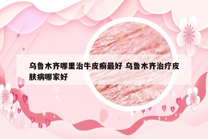 乌鲁木齐哪里治牛皮癣最好 乌鲁木齐治疗皮肤病哪家好