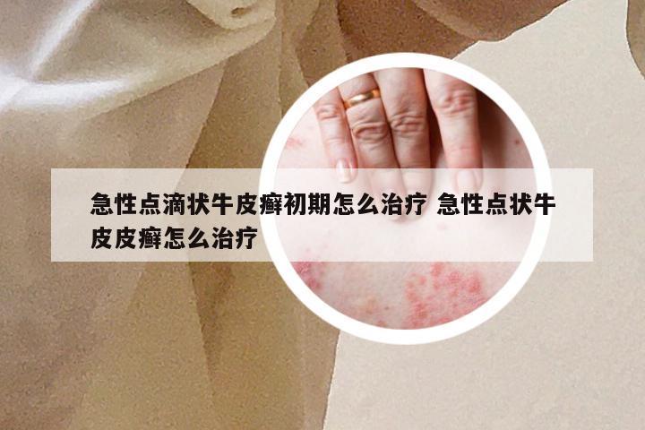急性点滴状牛皮癣初期怎么治疗 急性点状牛皮皮癣怎么治疗