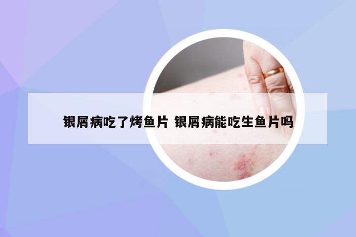 银屑病吃了烤鱼片 银屑病能吃生鱼片吗