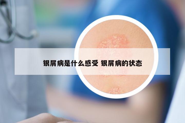 银屑病是什么感受 银屑病的状态