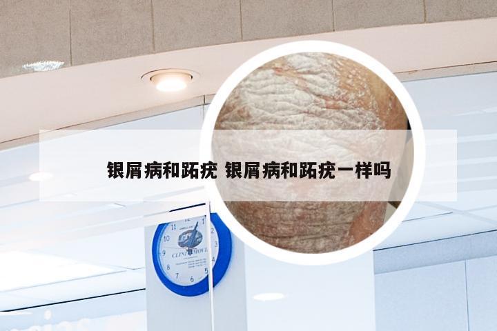 银屑病和跖疣 银屑病和跖疣一样吗