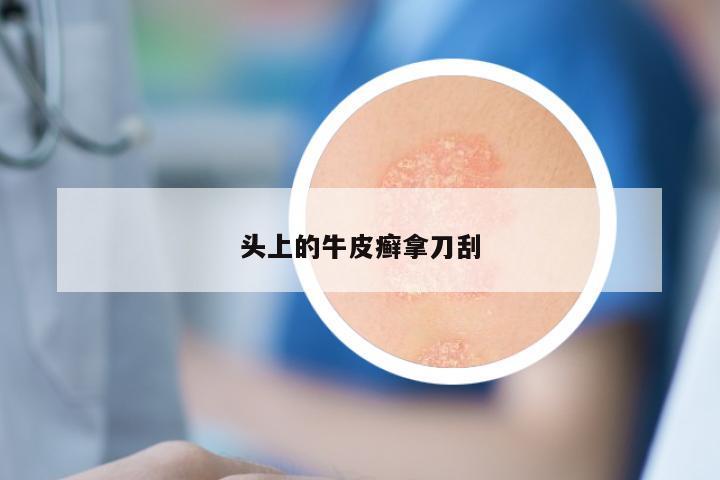 头上的牛皮癣拿刀刮