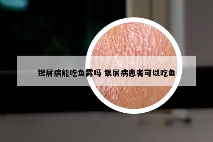 银屑病能吃鱼露吗 银屑病患者可以吃鱼