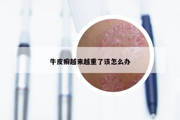 牛皮癣越来越重了该怎么办