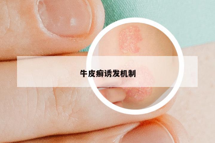 牛皮癣诱发机制