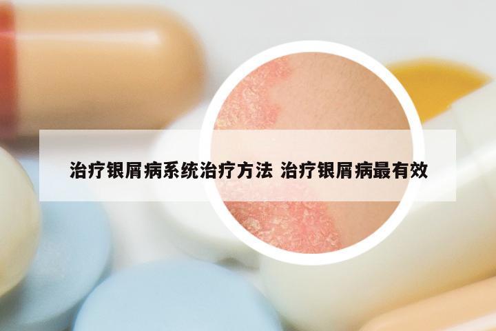 治疗银屑病系统治疗方法 治疗银屑病最有效