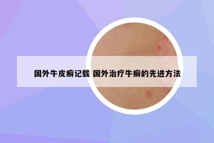 国外牛皮癣记载 国外治疗牛癣的先进方法