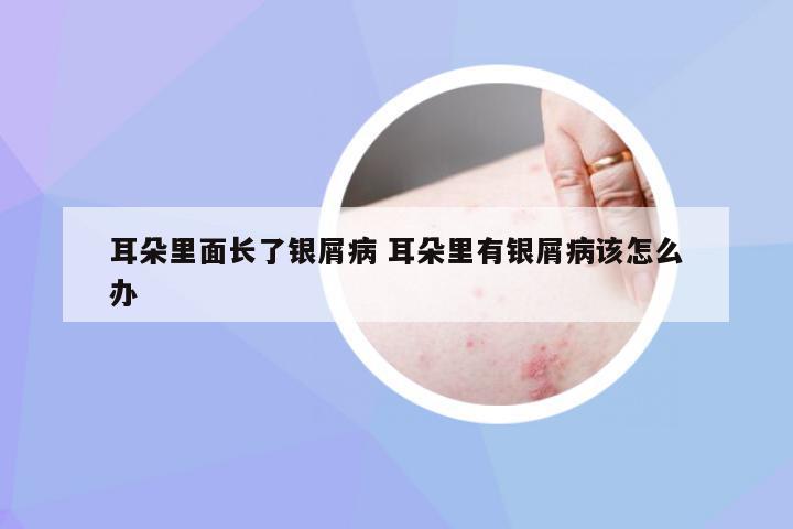 耳朵里面长了银屑病 耳朵里有银屑病该怎么办