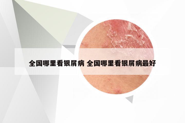 全国哪里看银屑病 全国哪里看银屑病最好