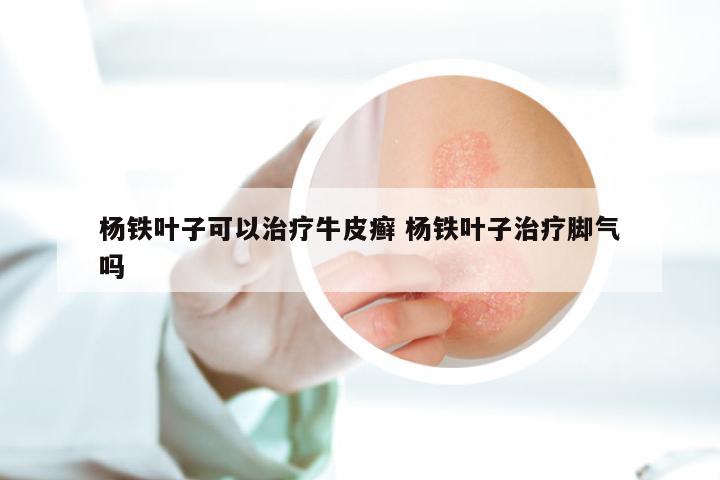 杨铁叶子可以治疗牛皮癣 杨铁叶子治疗脚气吗