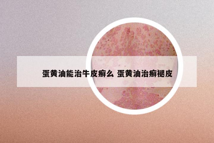 蛋黄油能治牛皮癣么 蛋黄油治癣褪皮