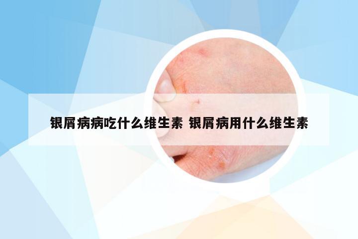 银屑病病吃什么维生素 银屑病用什么维生素