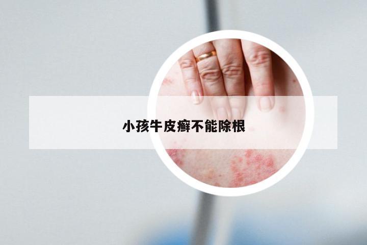 小孩牛皮癣不能除根