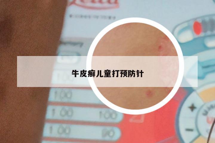 牛皮癣儿童打预防针