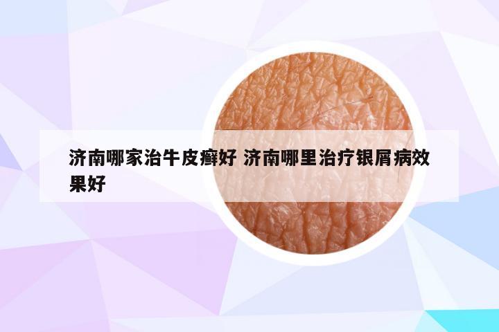 济南哪家治牛皮癣好 济南哪里治疗银屑病效果好