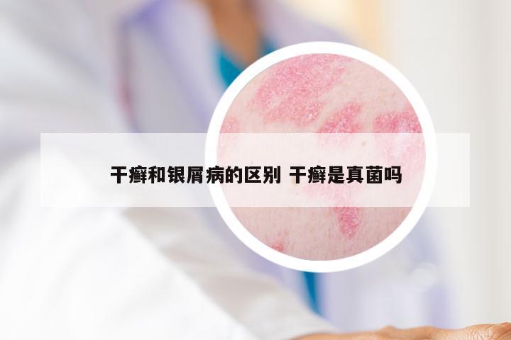 干癣和银屑病的区别 干癣是真菌吗