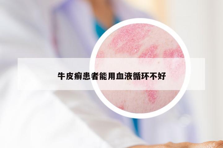 牛皮癣患者能用血液循环不好