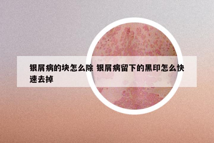 银屑病的块怎么除 银屑病留下的黑印怎么快速去掉