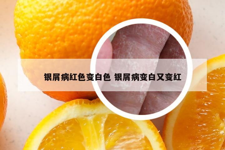 银屑病红色变白色 银屑病变白又变红