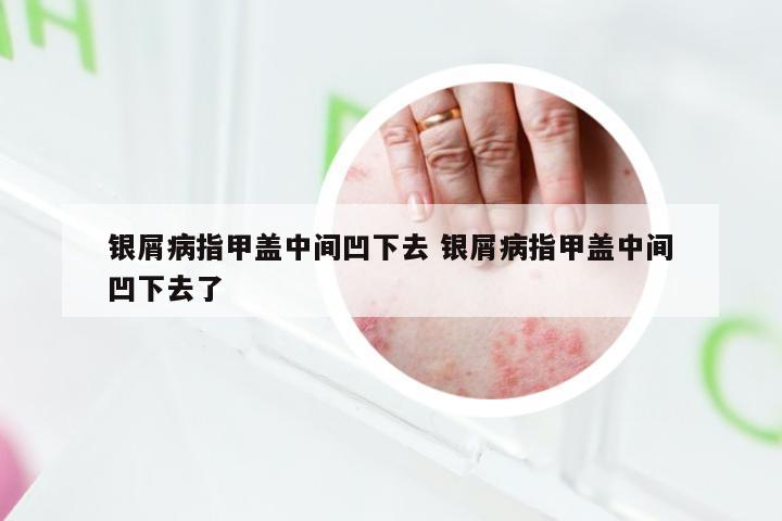 银屑病指甲盖中间凹下去 银屑病指甲盖中间凹下去了
