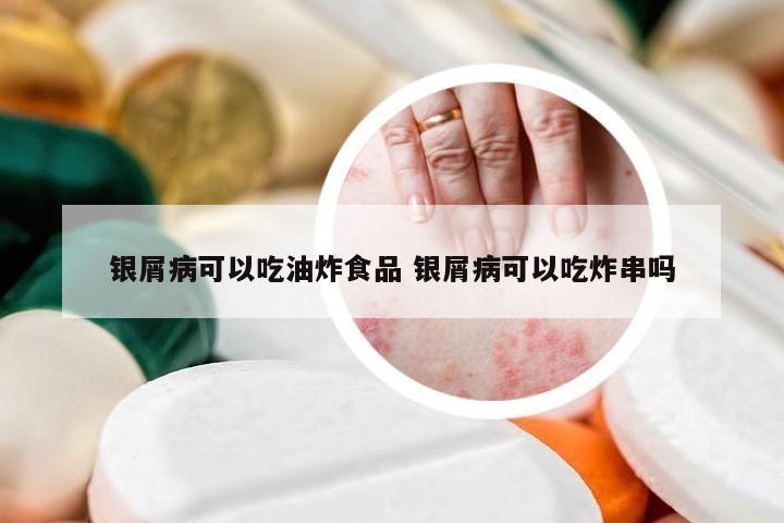 银屑病可以吃油炸食品 银屑病可以吃炸串吗