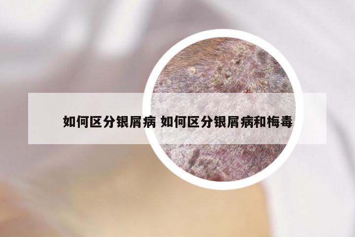 如何区分银屑病 如何区分银屑病和梅毒