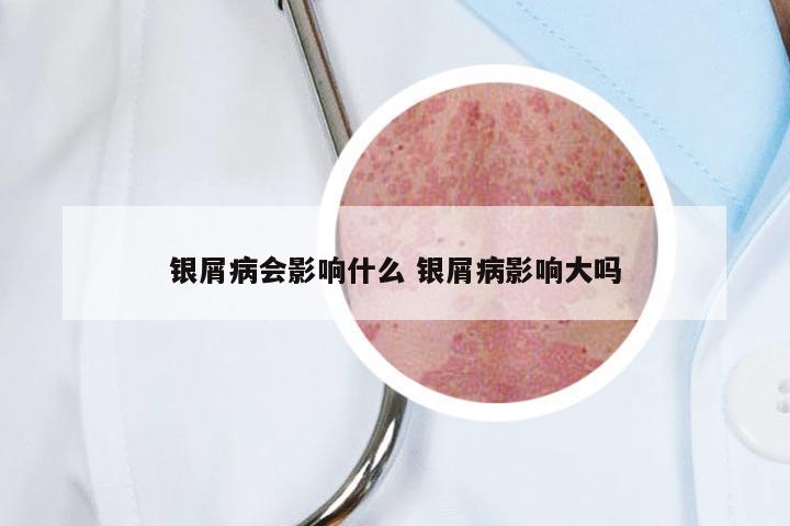 银屑病会影响什么 银屑病影响大吗