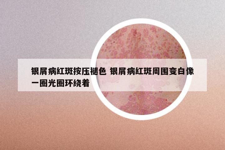 银屑病红斑按压褪色 银屑病红斑周围变白像一圈光圈环绕着