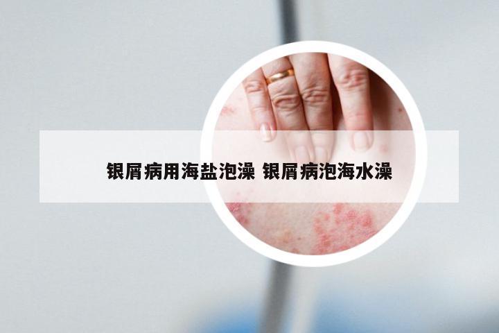 银屑病用海盐泡澡 银屑病泡海水澡