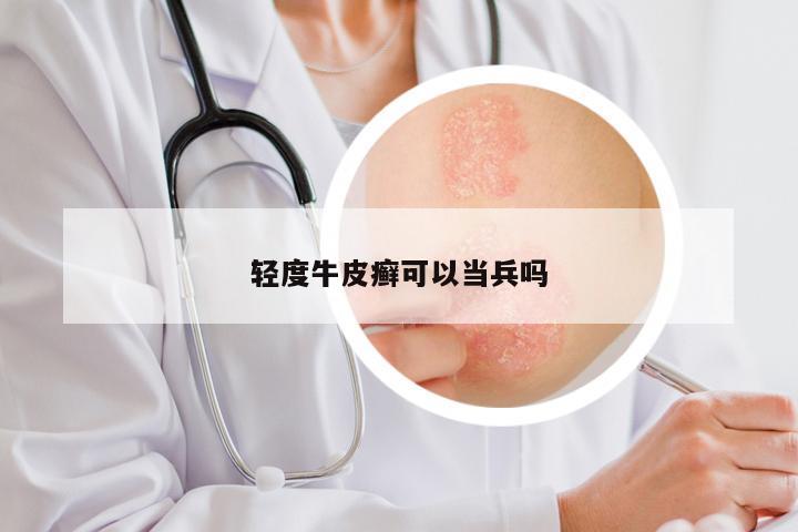 轻度牛皮癣可以当兵吗