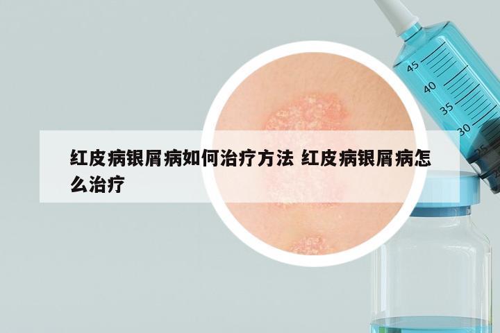 红皮病银屑病如何治疗方法 红皮病银屑病怎么治疗