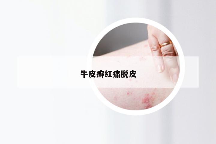 牛皮癣红痛脱皮